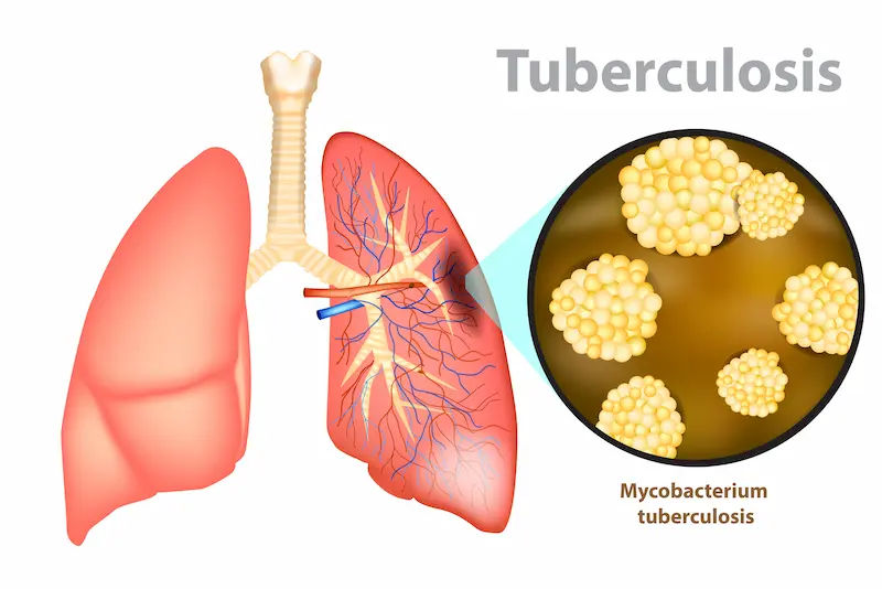 Guide to How Tuberculosis Affects Immunity